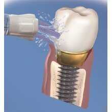 dyqan taxi ultra waterpik flosser per implante